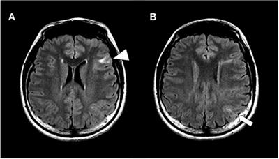 Resective Surgery for Double Epileptic Foci Overlapping Anterior and Posterior Language Areas: A Case of Epilepsy With Tuberous Sclerosis Complex